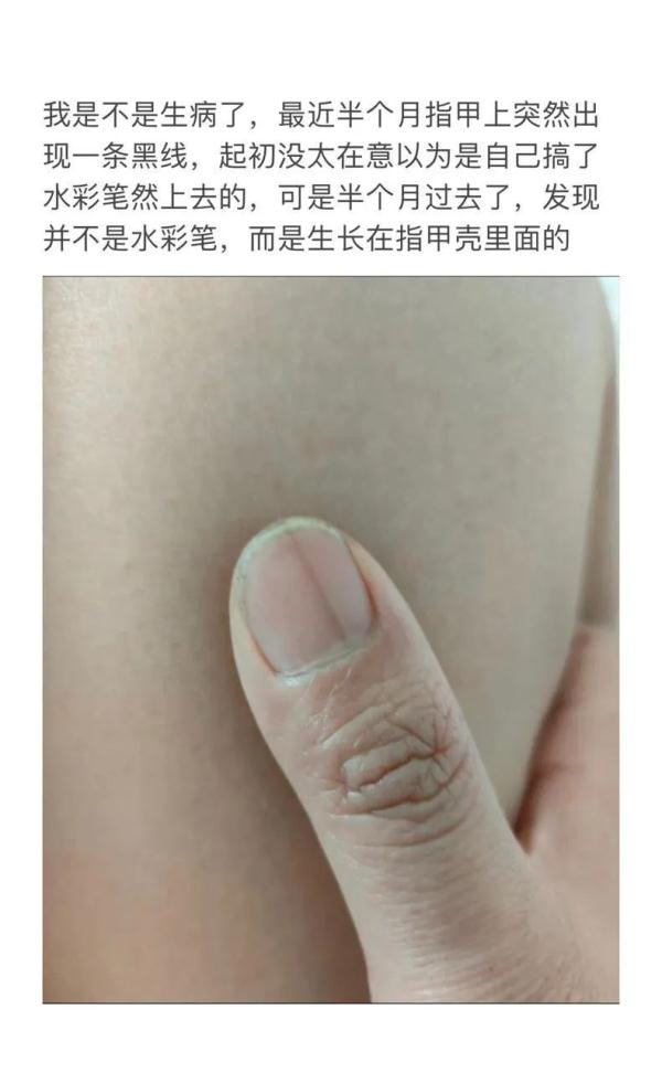 冲上热搜！指甲上突然长黑线，网友们慌了
