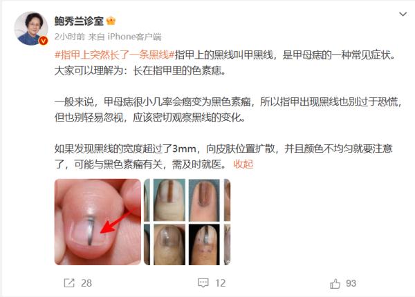 热搜！指甲上长出一条黑线，网友慌了……