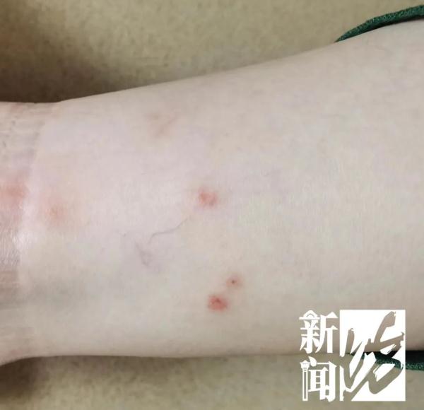 伤口看得头皮发麻！小区居民36℃恨不得长袖长裤？