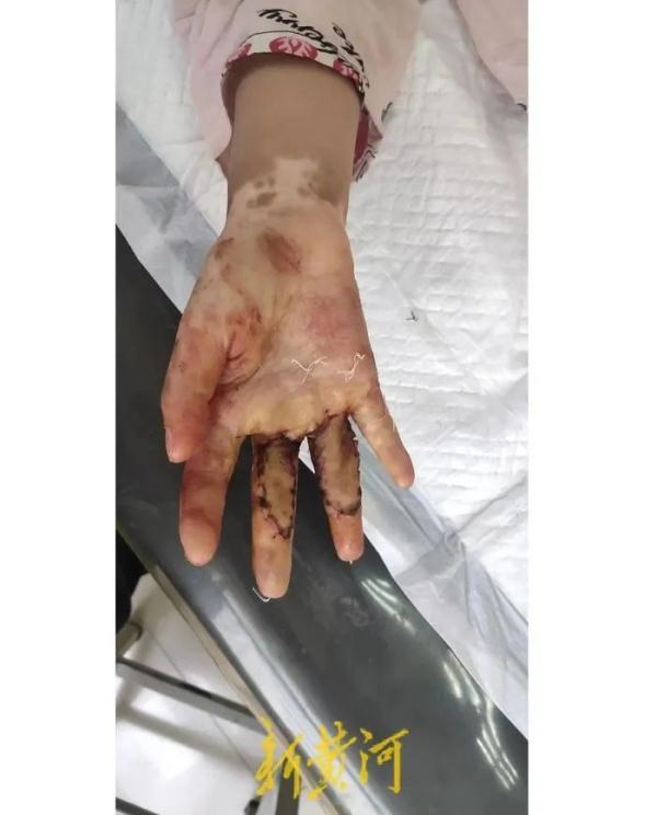 热水烫、殴打……女童遭继母虐待致残，其父称绝不和解