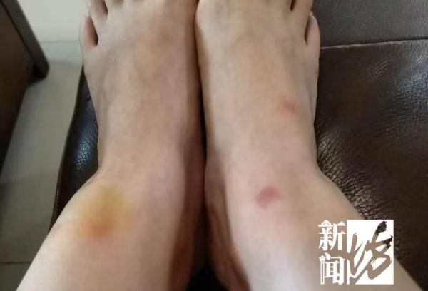 伤口看得头皮发麻！小区居民36℃恨不得长袖长裤？