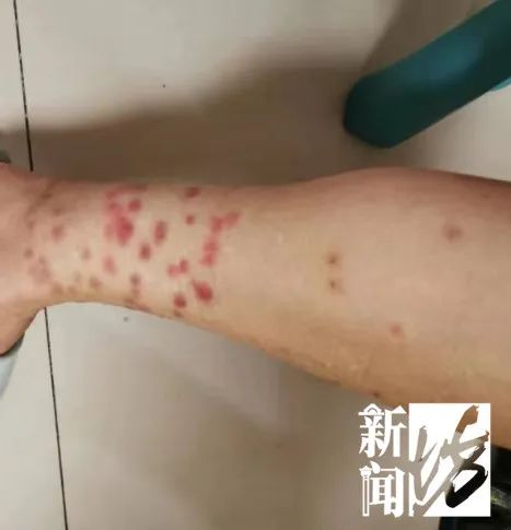 伤口看得头皮发麻！小区居民36℃恨不得长袖长裤？