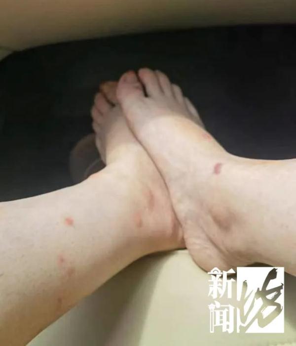 伤口看得头皮发麻！小区居民36℃恨不得长袖长裤？