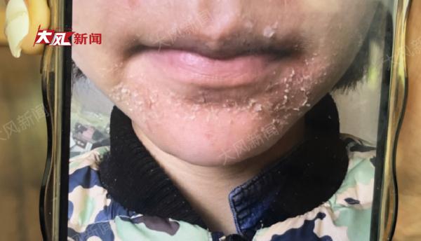 朋友圈买护肤品汞超标33万倍，多名女子投诉使用后烂肤、流产…