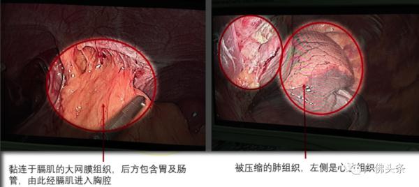 吓人！小伙宵夜后腹绞痛，左胸竟被胃“填满”！医生提醒：别再这样干