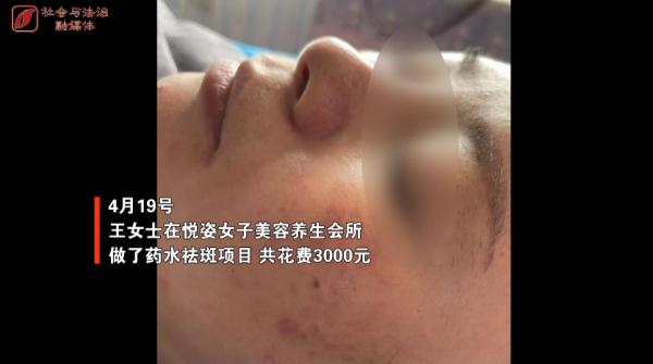 “美容”变“毁容” 女子祛斑不成反长一脸黑“斑”……