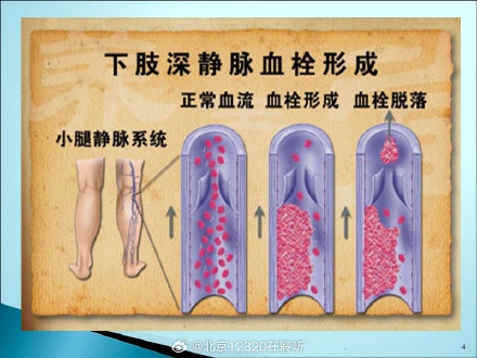 帮你了解什么是下肢深静脉血栓后综合征