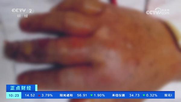 因一条罗非鱼，男子痛失手指！被鱼刺伤别不当回事