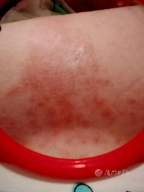 厦门一女子游泳后身上出现大面积红斑,痛到睡不着!近期发生多起 厦门一女子游泳后身上出现大面积红斑,痛到睡不着!近期发生多起