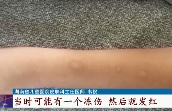 高温天气10岁男童竟被冻伤,这种网红清凉神器慎用→ 高温天气10岁男童竟被冻伤,这种网红清凉神器慎用→