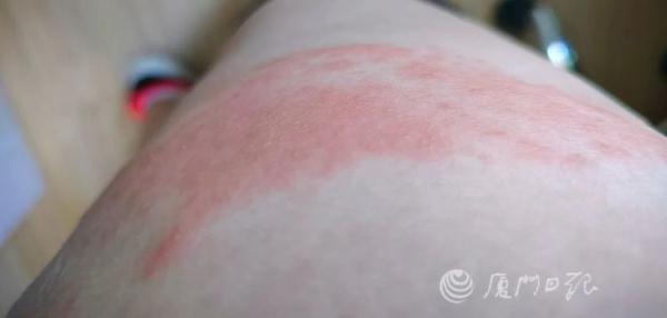 厦门一女子游泳后身上出现大面积红斑,痛到睡不着!近期发生多起 厦门一女子游泳后身上出现大面积红斑,痛到睡不着!近期发生多起