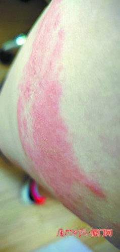 盛夏海滨玩水 当心有毒水母