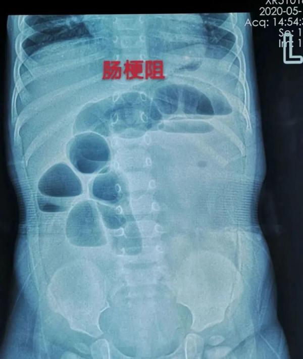 小心！又有孩子因为这种玩具住院 很多人家里都有