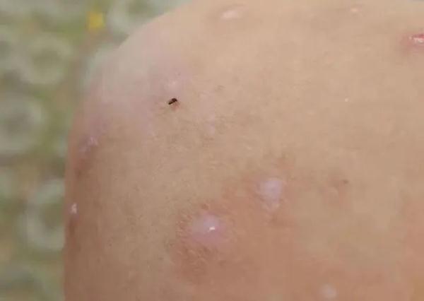 这个“吸血鬼”，比蚊子还猛还难缠！5招能治它