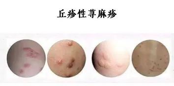 这个“吸血鬼”，比蚊子还猛还难缠！5招能治它