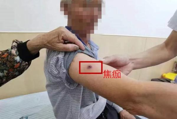 一地近10人确诊!早期症状像感冒,严重可致命! 一地近10人确诊!早期症状像感冒,严重可致命!