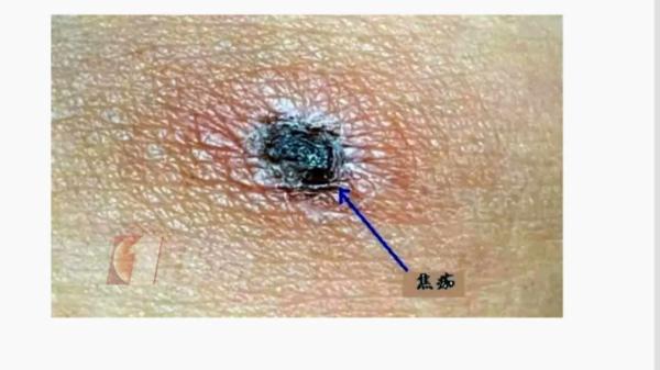 小虫子大麻烦！这种病近期高发，如何做到别来无“恙”？