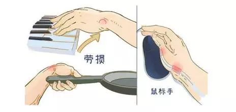 用手过多当心腱鞘炎 教你几个动作舒缓预防