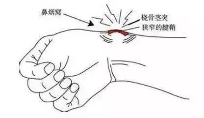 用手过多当心腱鞘炎 教你几个动作舒缓预防