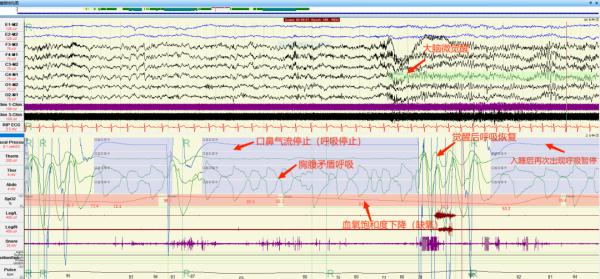 “倒头就睡”一定是睡眠很好？如伴有这些症状需警惕