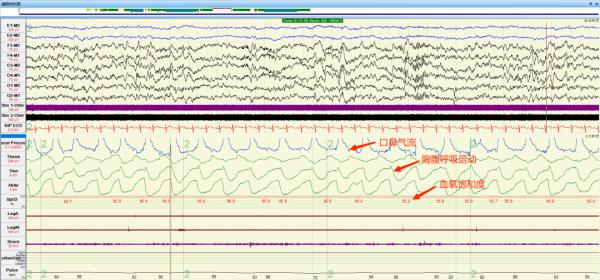 “倒头就睡”一定是睡眠很好？如伴有这些症状需警惕