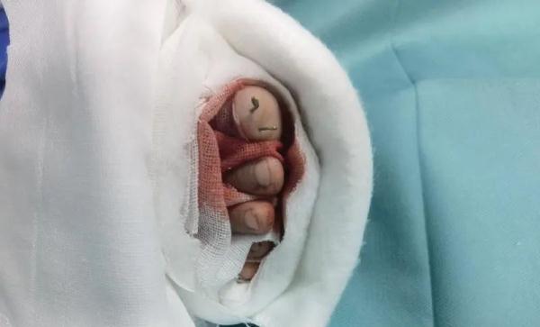 痛心!4岁男童在商场脚趾被夹断,出门玩要当心这些 痛心!4岁男童在商场脚趾被夹断,出门玩要当心这些