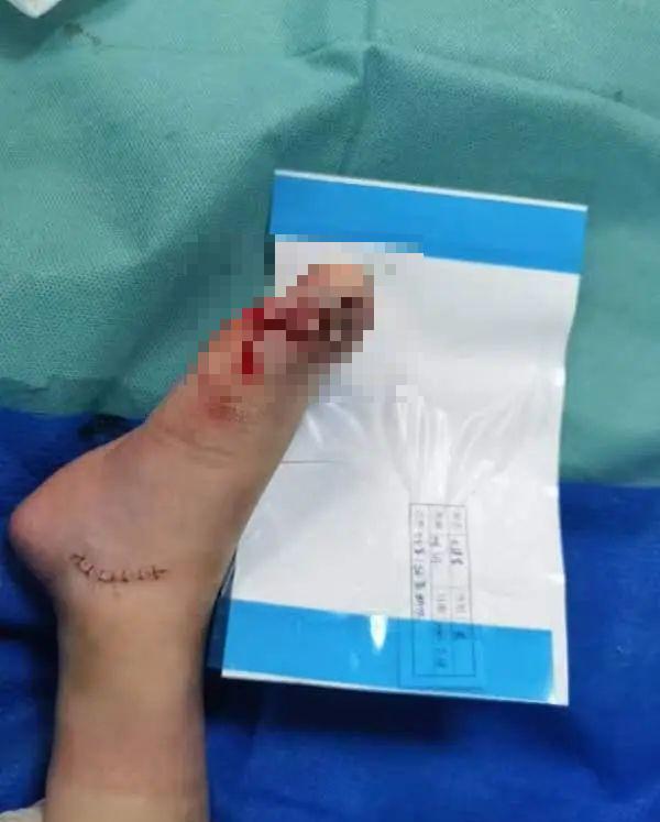 痛心!4岁男童在商场脚趾被夹断,出门玩要当心这些 痛心!4岁男童在商场脚趾被夹断,出门玩要当心这些