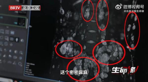 警惕长出这种斑！22岁女孩体内发现上千颗肿瘤，痛到只能半跪在床