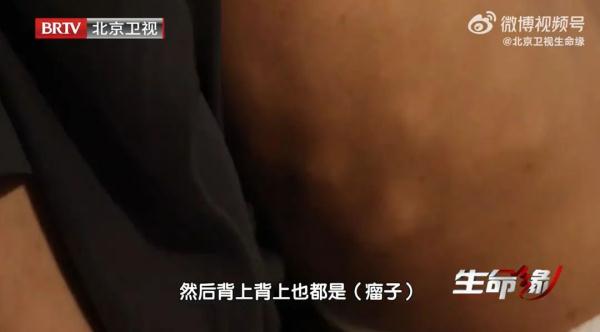 警惕长出这种斑！22岁女孩体内发现上千颗肿瘤，痛到只能半跪在床