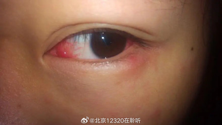 眼睛突然红了怎么办？