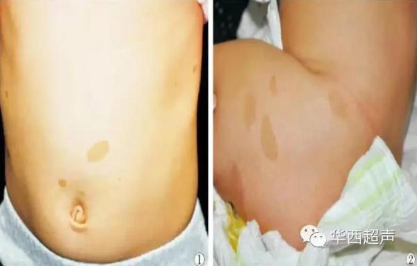 警惕长出这种斑！22岁女孩体内发现上千颗肿瘤，痛到只能半跪在床