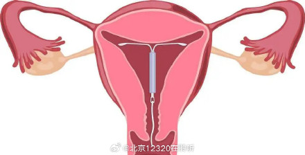避孕环超过年限没有取出,会有什么后果? 避孕环超过年限没有取出,会有什么后果?