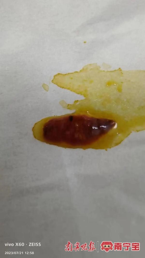 头皮发麻！一女子体内惊现大量“瓜子”活虫，只因家人爱吃鱼生