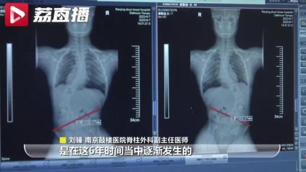 仅3周接诊5名下腰瘫痪孩子！家长注意这个动作