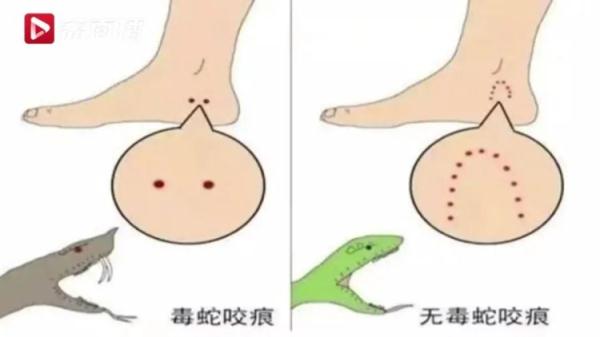 7月一医院收治被蛇咬伤患者60多例！夏季高发！