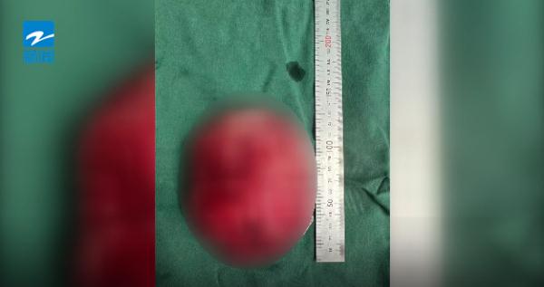 浙江一13岁女孩胸部变大,以为是发育,去医院一查,没想到是纤维瘤 浙江一13岁女孩胸部变大,以为是发育,去医院一查,没想到是纤维瘤