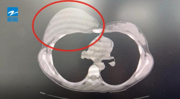 浙江一13岁女孩胸部变大,以为是发育,去医院一查,没想到是纤维瘤 浙江一13岁女孩胸部变大,以为是发育,去医院一查,没想到是纤维瘤