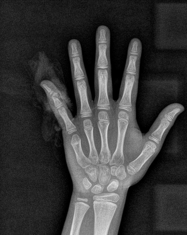 手指离断！长沙这家医院一个月接诊近十例，暑期意外伤害需警惕