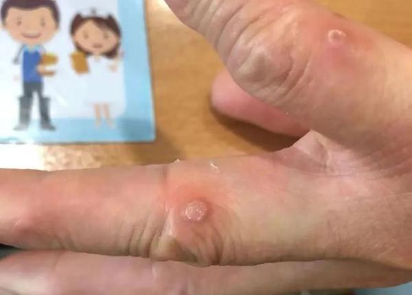 游完泳，10岁孩子连得3种病，甚至有孩子要动手术！医生紧急提醒