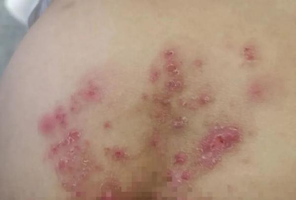 游完泳，10岁孩子连得3种病，甚至有孩子要动手术！医生紧急提醒