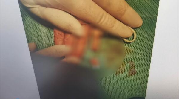 孩子下楼玩手指却断了……这个东西玩不得