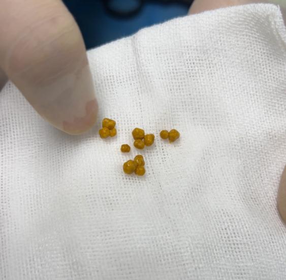 小结石大麻烦！女子胰腺炎反复发作，罪魁祸首竟是胆囊结石