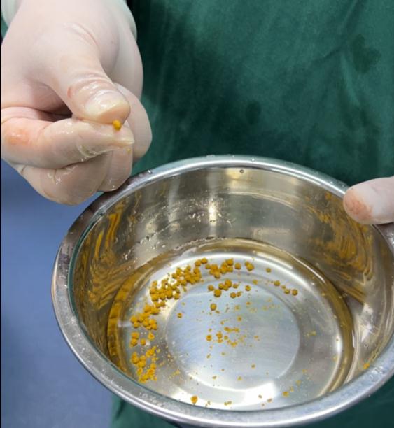 小结石大麻烦！女子胰腺炎反复发作，罪魁祸首竟是胆囊结石