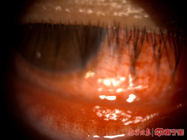 曾用酒店毛巾擦拭身体！男子莫名染上这种病