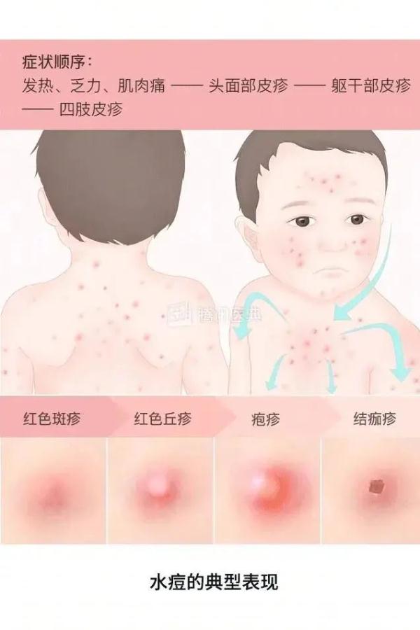 紧急提醒！这病毒“见面传”，大人小孩都易感染