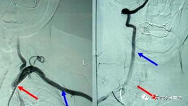 女子吃完一顿饭，竟患上“东方美女病”？医生提醒→