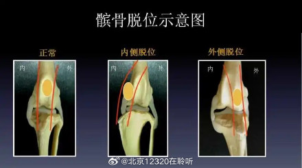 髌骨脱位是如何发生的？