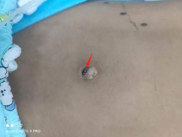 可怕!厦门:6岁男童高烧10多天!医生在他肚脐找到…… 可怕!厦门:6岁男童高烧10多天!医生在他肚脐找到……