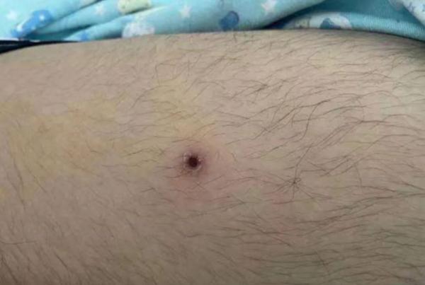 可怕!厦门:6岁男童高烧10多天!医生在他肚脐找到…… 可怕!厦门:6岁男童高烧10多天!医生在他肚脐找到……