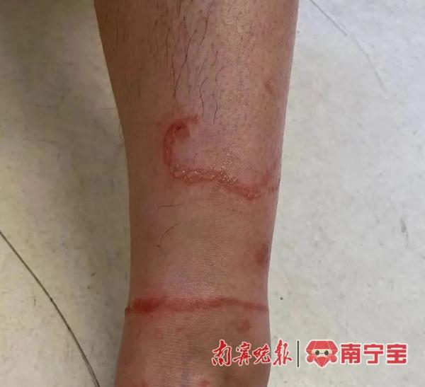 近期多发！孩子被红火蚁咬伤、被海蜇蜇伤，紧急提醒→